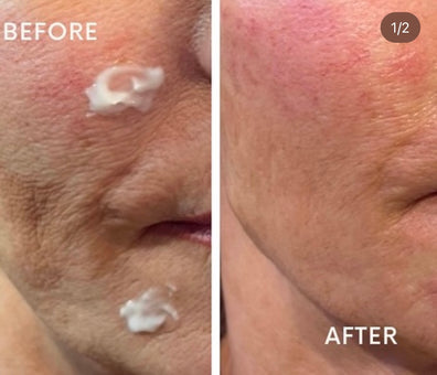 Profhilo Gosforth Newcastle by advanced and experienced aesthetics practitioner Kate